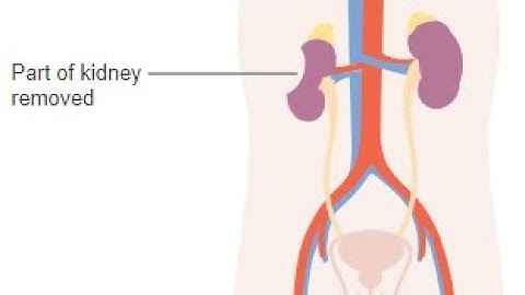 Nephrectomy CPT code - simplify medical coding