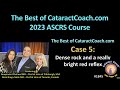 Cataractcoach1845 ascrs 2023 course case 5 dense cataract  bright red reflex