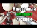 Иммедиальный (мгновенный) имплант и лечение зубов лазером | Доктор Туран Гюльдаш