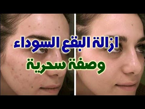 كيفيه ازاله البقع السوداء الداكنه في الوجه وازاله السواد حول الفم وتبييض الوجه من اول استعمال