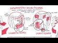 Inflammatory Bowel Disease - Crohns and Ulcerative Colitits