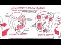 Inflammatory Bowel Disease (Overview, Crohn's and Ulcerative Colitis) Mp3 Song