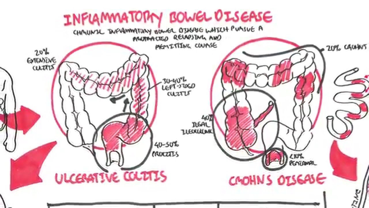 Inflammatory Bowel Disease - Crohns and Ulcerative Colitits