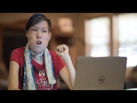 Vlogger With Facial Tumour Beats The Bullies By Singing: BORN DIFFERENT Hqdefault