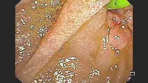 Large impacted CBD stone, Spy Glass Holmiumlaser lithotripsy