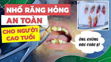 Nhổ 6 Răng Cửa Bị Lung Lay, Tiêu Xương Thường Gặp Ở Người Cao Tuổi