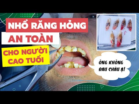 Video Nhổ 6 Răng Cửa Bị Lung Lay, Tiêu Xương Thường Gặp Ở... - youtube