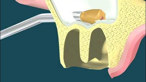 Dental Video of Root Tip in Sinus Retraction - The Tooth