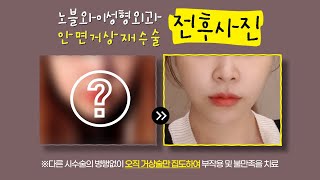 안면거상재수술 십수년 넘게 집도해온 노블와이 김창연원장 (★더보기란 필독★)