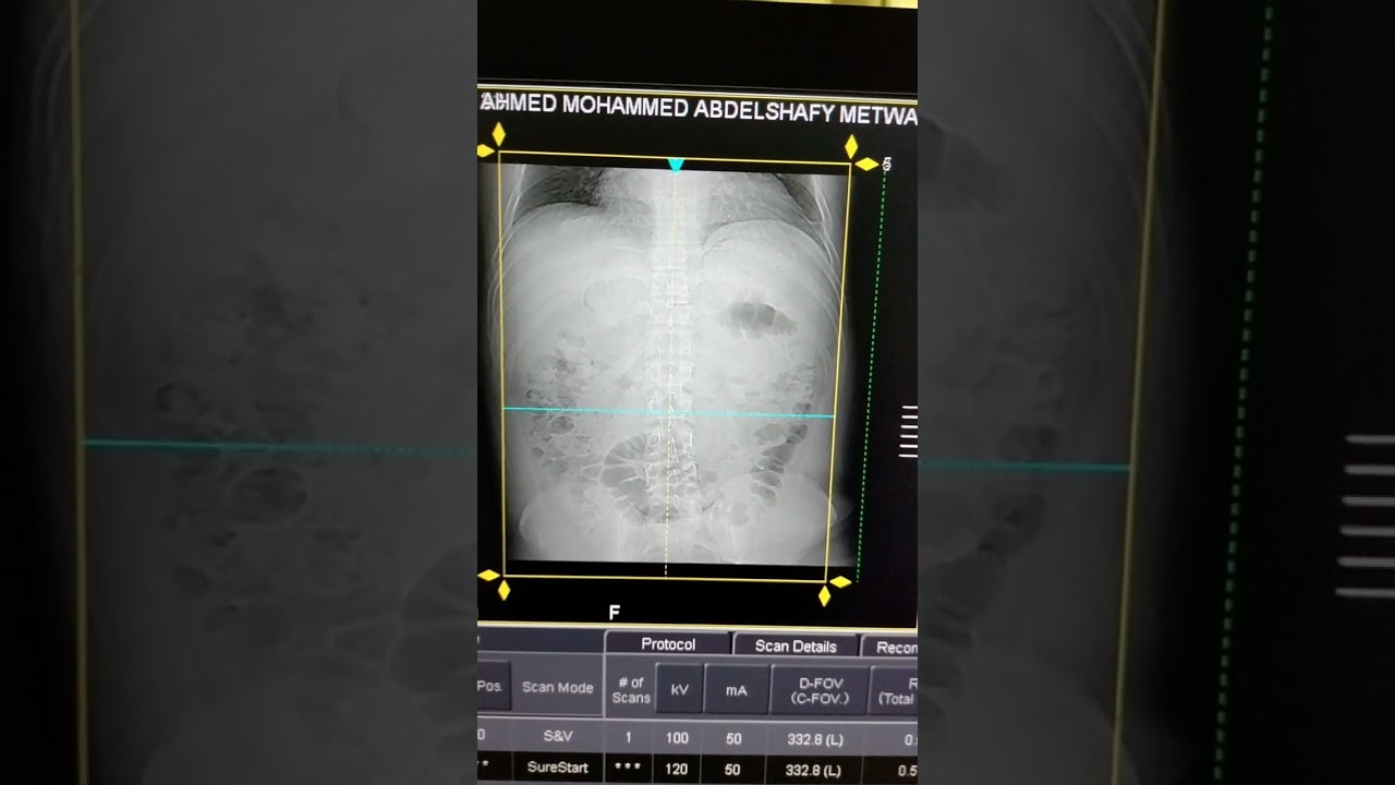 شرح فحص الاشعه المقطعيه ثلاثية المراحل  / Triphasic ct scan