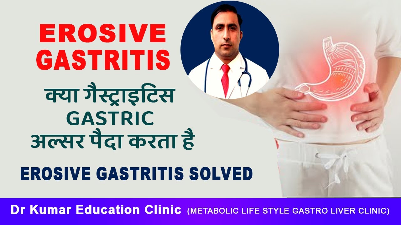 EROSIVE GASTRITIS EROSIVE GASTRITIS