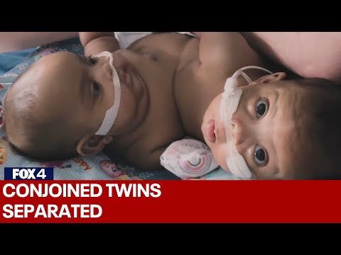 FULL VIDEO: Conjoined twins separated at Cook Children's Medical Center