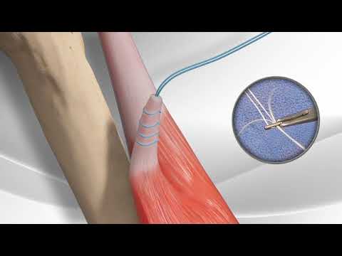 Video: Waarom een biceps-tenotomie?