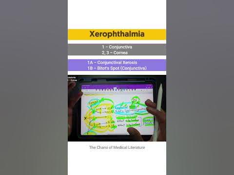 Xerophthalmia | Vitamin A Deficiency #tcml #shorts #shortsyoutube 