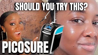 PicoSure: Bet You Haven't Tried *THIS* for Hyperpigmentation Laser Pico