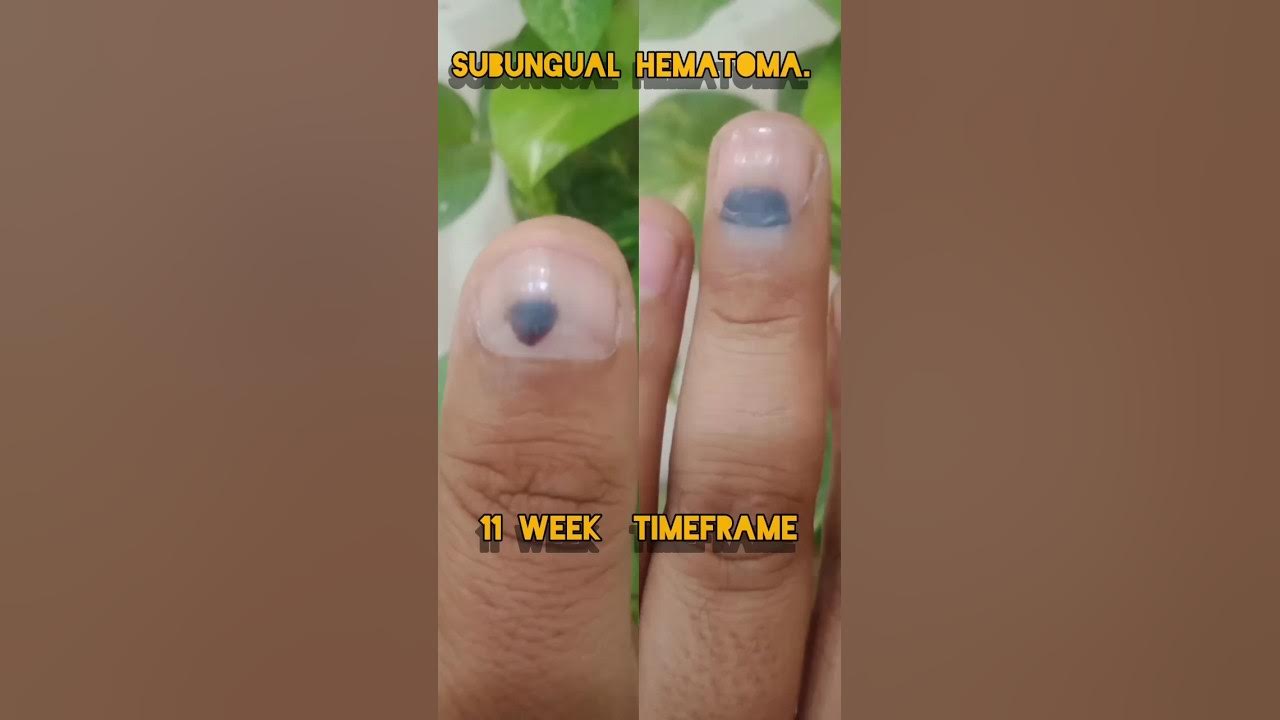Subungual Melanoma How Long To Develop