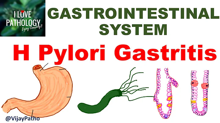 H Pylori Gastrit: Utbredning, Patogenes och Behandling