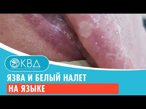 👅 Язва и белый налет на языке. Клинический случай №798