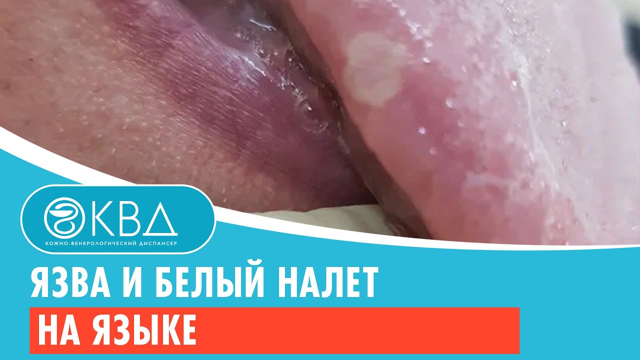 👅 Язва и белый налет на языке. Клинический случай №798