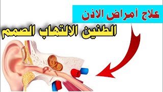 علاج امراض الاذن الطنين الالتهاب الصمم