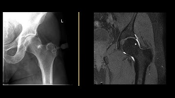 What is an MRI hip arthrogram?