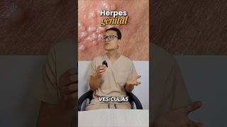 Las ampollas genitales o vesículas son causadas por herpes tipo 2 #vph #verrugas