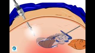 In-Bag Morcellation Tutorial using LIMAS Safety Isolation Bag