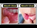 🔥मूंह के छाले क्यों होते हैं।। मूंह के छाले कैसे ठीक करें।। How to cure mouth ulcer।।#trending Mp3 Song