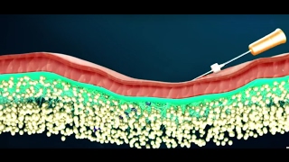 How Does Cutis PDO Thread Lift Procedure Work screenshot 4