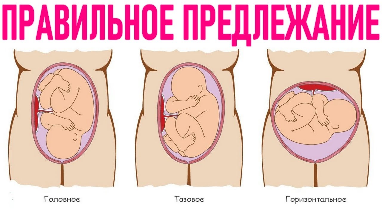 ПРАВИЛЬНОЕ ПОЛОЖЕНИЕ РЕБЕНКА ВО ВРЕМЯ БЕРЕМЕННОСТИ | Чем отличается головное предлежание плода