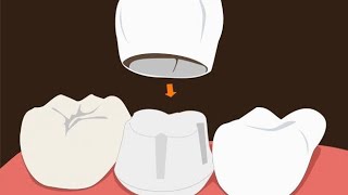 طربوش الأسنان🦷 Direct composite dental crown👑🔥