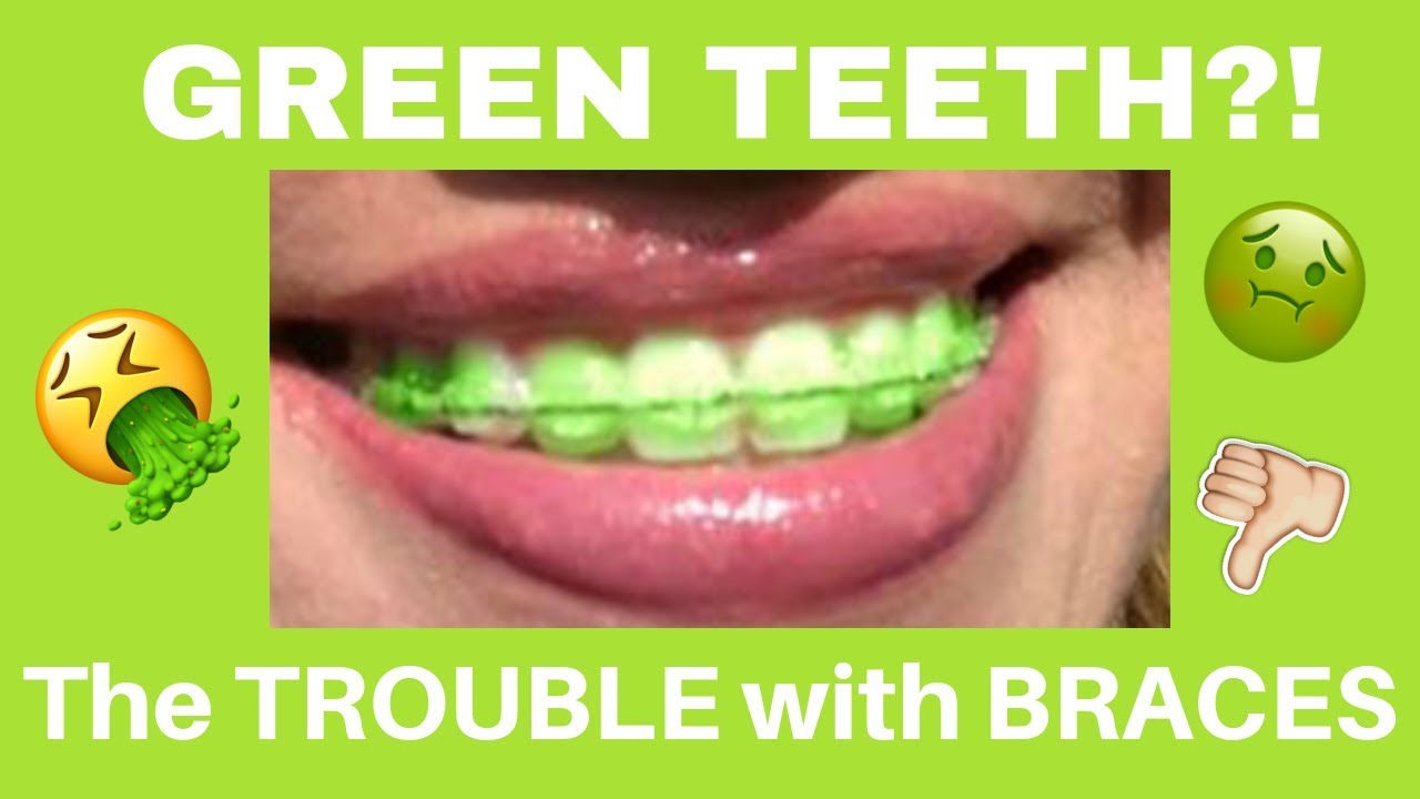 🔴LIVE GREEN TEETH?! 🤮🤢🤮 BRACES PROBLEMS... YouTube