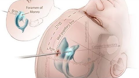 EVD Insertion| External Ventricular Drain| Kocher’s Point| NEUROSURGERY| Dr Anil Kothiwala