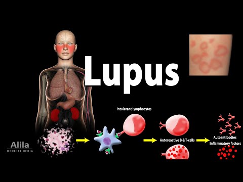 Lupus: Symptoms, Risk factors, Pathophysiology, Diagnosis and Treatments.