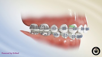 Elastics   Class II Box