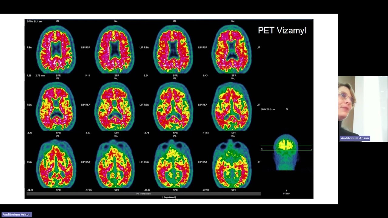 הרצאה - עידן חדש באבחון ובטיפול באלצהיימר, ד"ר תמרה שיינר, ד"ר נעה ברגמן - המערך הנוירולוגי, איכילוב
