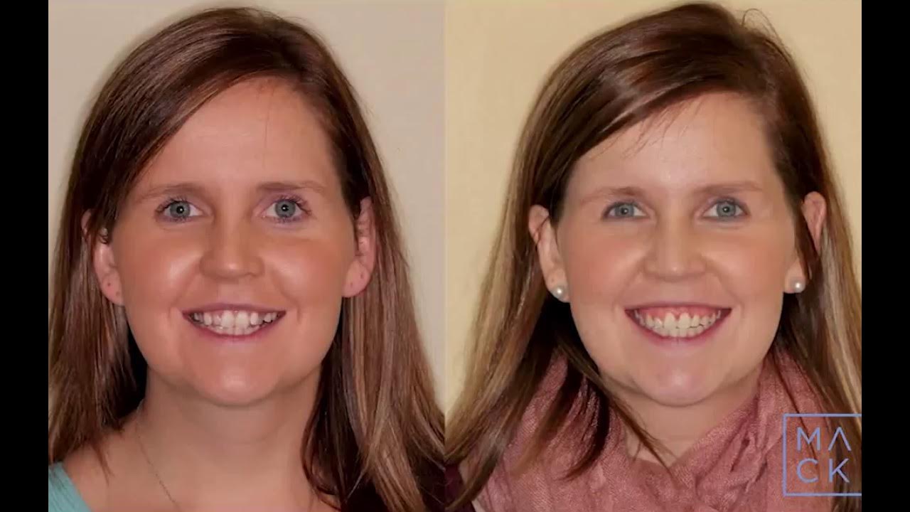 Before and After with Metal Braces for Crossbite Correction YouTube