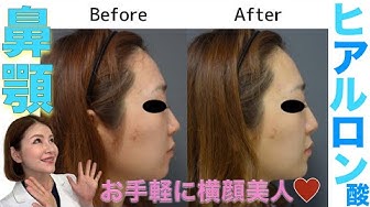 ヒアルロン酸 Youtube ヒアルロン酸 Youtube