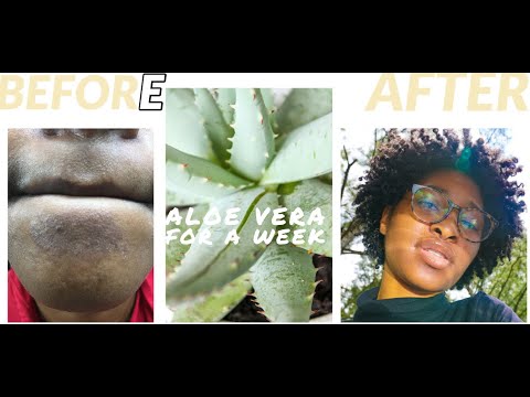 Video: Melasma-kotihoitokeinot: Aloe Vera, Glutationi, Traneksaamihappo