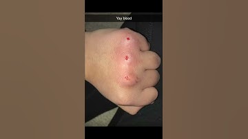 Thumbnail of Y’all I tried the bloody knuckle game