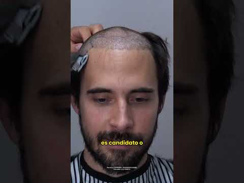 #tbt ¿Tienes diabetes y estás pensando en un injerto capilar?