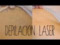Depilación láser: 7 cosas que debes saber