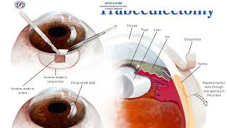 What is Glaucoma? Silent Vision Thief Explained | Causes, Symptoms & Treatment Glaucoma Explained The Silent Vision Thief
