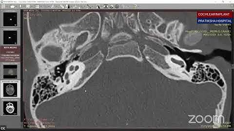 Radiology for Cochlear Implantation