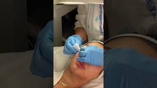 Deep extractions | Skincare90210