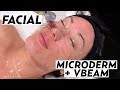 Getting a facial with microdermabrasion  vbeam laser with vanessa hernandez  skincare susan yara