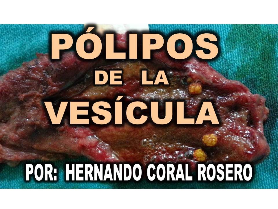que es un polipo en el higado que es un polipo en el higado