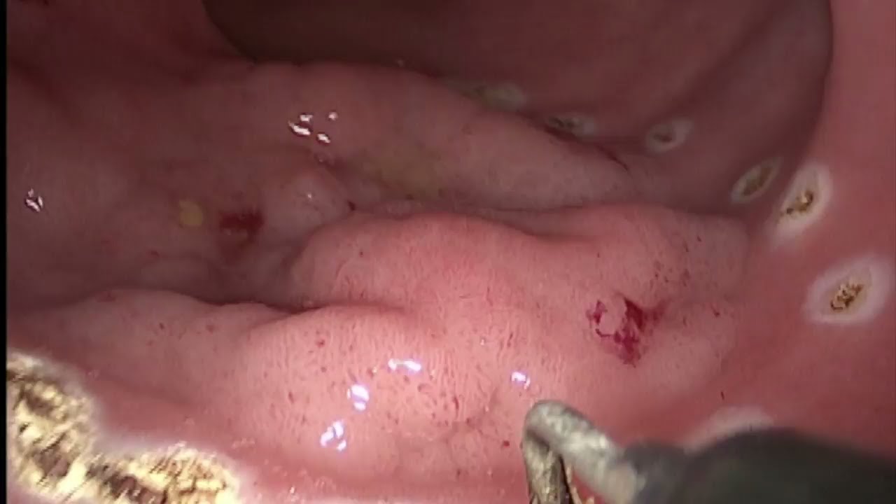 Transanal Minimally Invasive Surgery (TAMIS) for Excision of Rectal LST