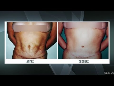 Cirugía para después del embarazo - elimina estrias - Experto en cicatrices  de Abdominoplastia - YouTube