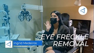 Ingrid Medeiros Eye Freckle Removal Treatment Experience.